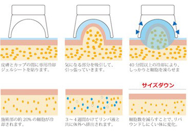 脂肪冷却ダイエット仕組み | i-salon